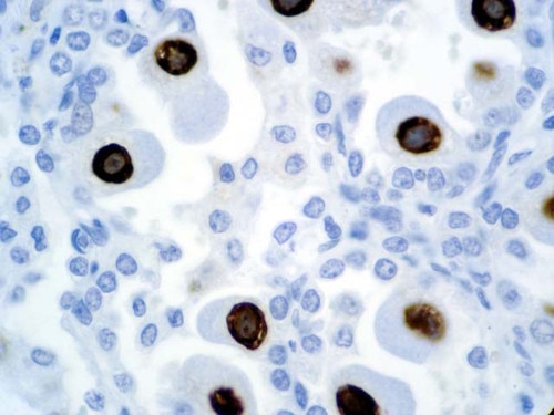 IHC of Cytomegalovirus on an FFPE Infected Lung Tissue